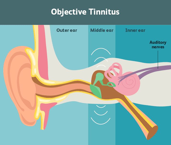objective Tinnitus