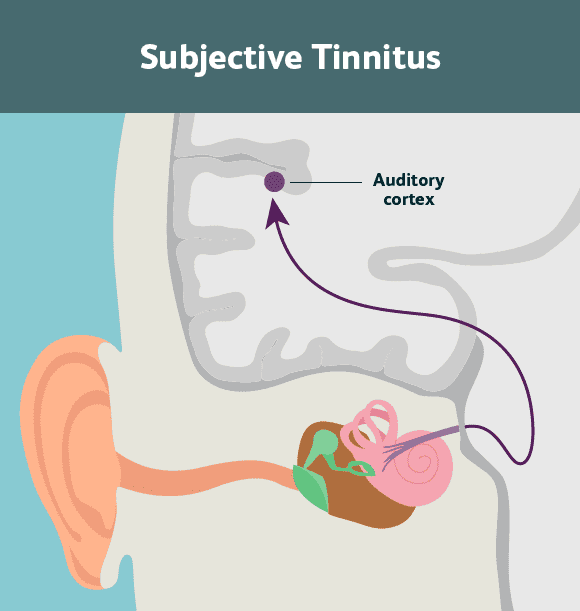 Subjective Tinnitus
