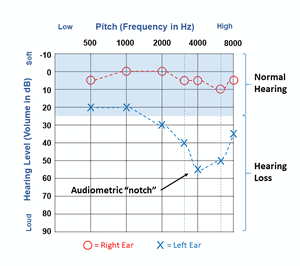 Typical Audiometric  Noise Notch 